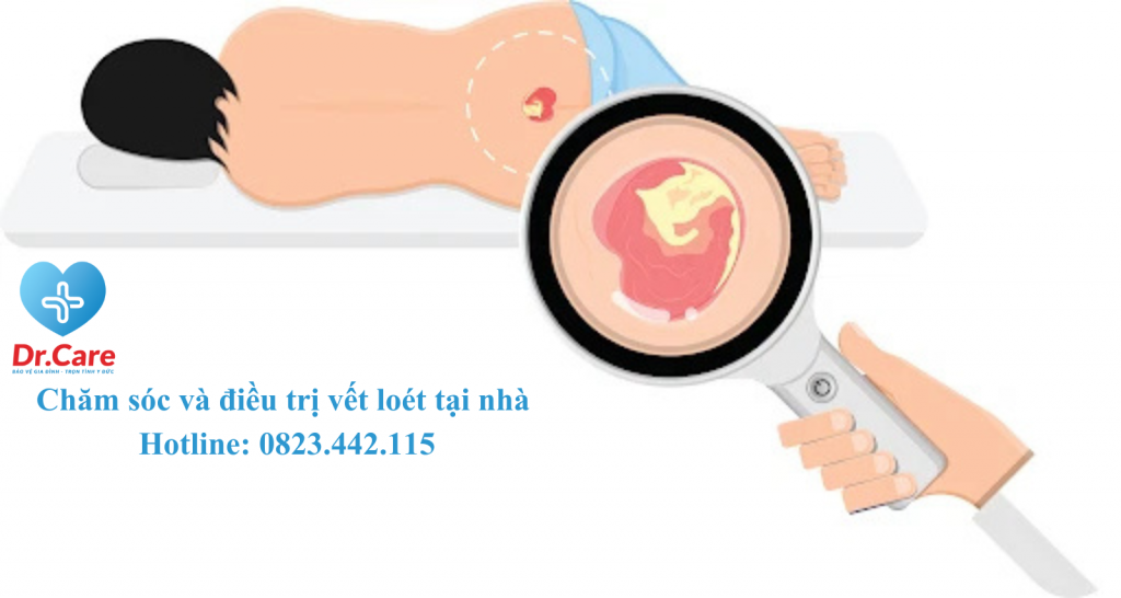CHĂM SÓC VÀ ĐIỀU TRỊ CHO NGƯỜI CAO TUỔI CÓ LOÉT DO TỲ ĐÈ Ở CÁC MỨC ĐỘ NGAY TẠI NHÀ VÀ CÁCH DỰ PHÒNG HIỆU QUẢ NHẤT