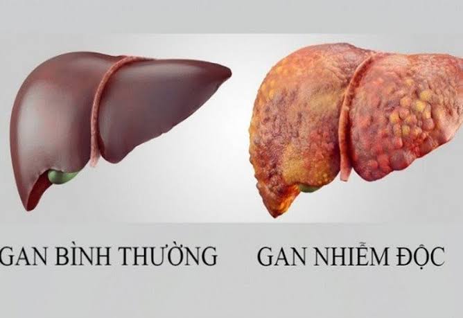 Livercare Therapy Dr.Care – Liệu trình thải độc gan chuyên sâu dành riêng cho người hay uống rượu bia và các chất kích thích